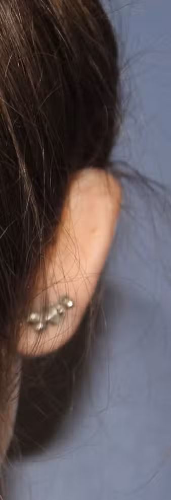 Otoplasty in Boston, MA