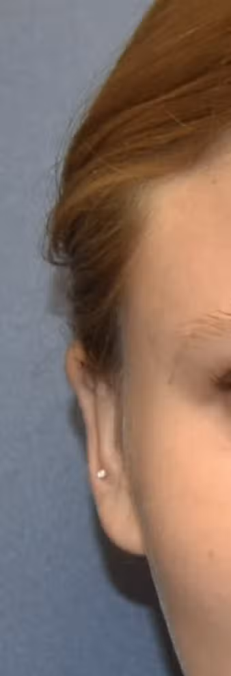 Otoplasty in Boston, MA