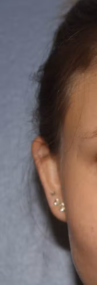 Otoplasty in Boston, MA