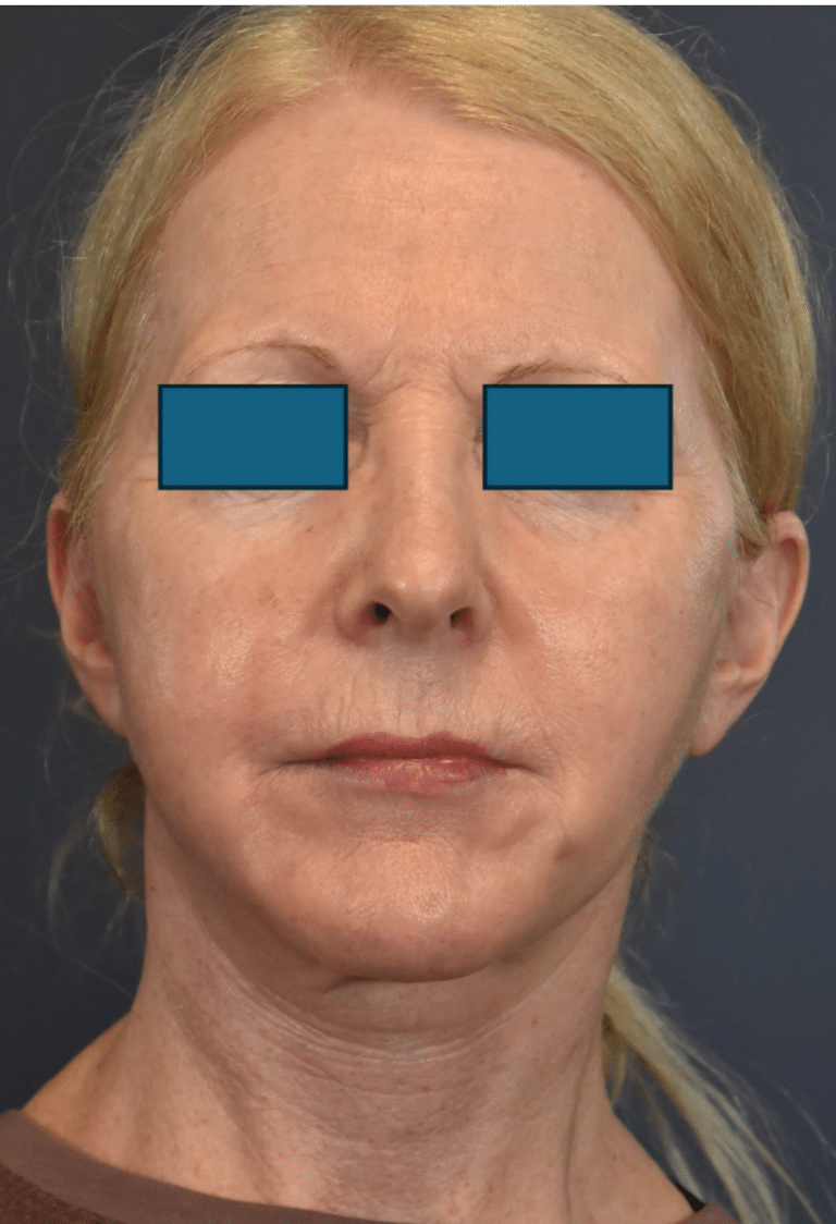 After Image: Facelift and Neck Lift - front
