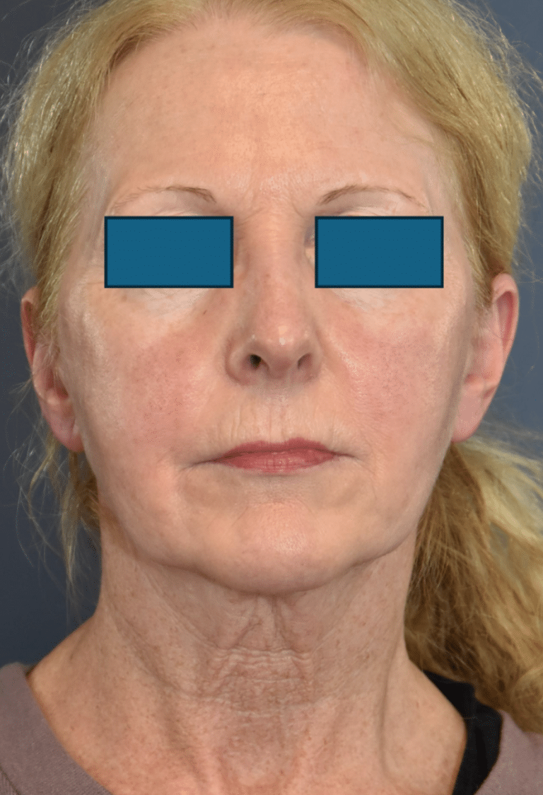 Before Image: Facelift and Neck Lift - front