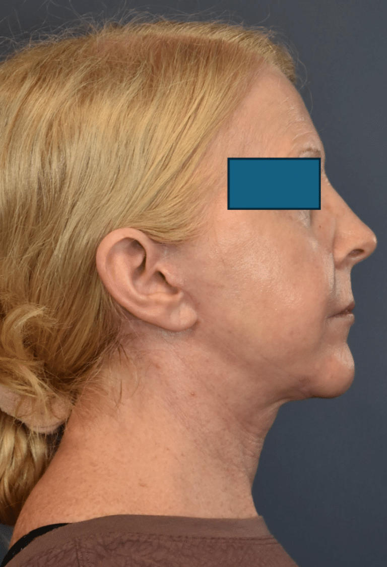After Image: Facelift and Neck Lift - right-side