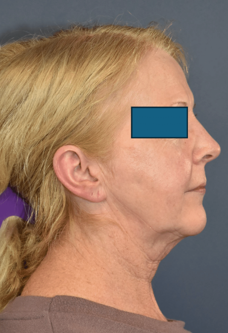 Before Image: Facelift and Neck Lift - right-side