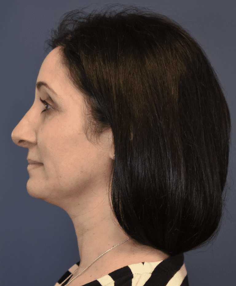 After Image: Rhinoplasty - left-side