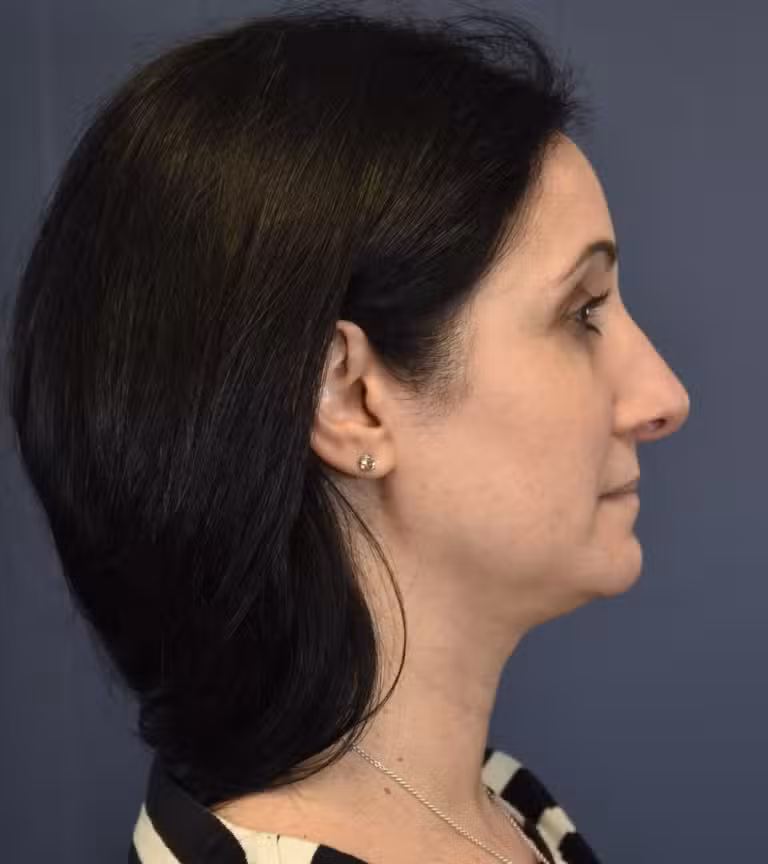 After Image: Rhinoplasty - right-side