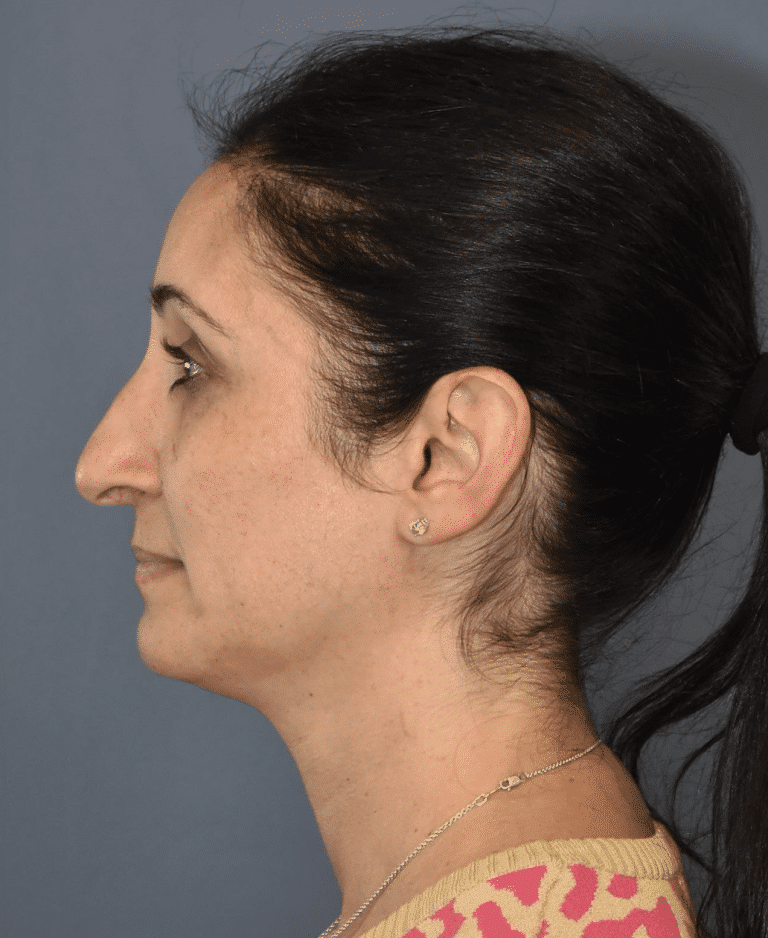 Before Image: Rhinoplasty - left-side