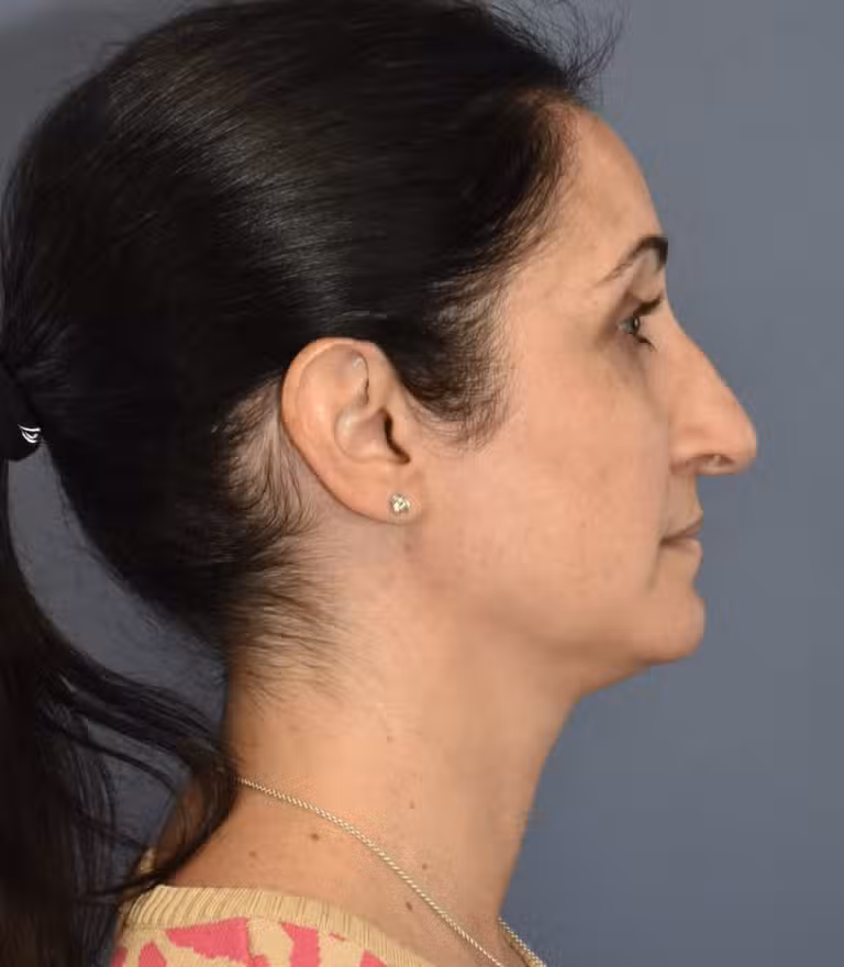 Before Image: Rhinoplasty - right-side