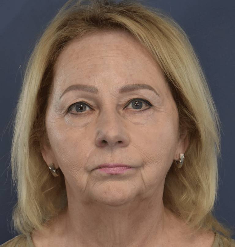 Before Image: Facelift and Neck Lift - front