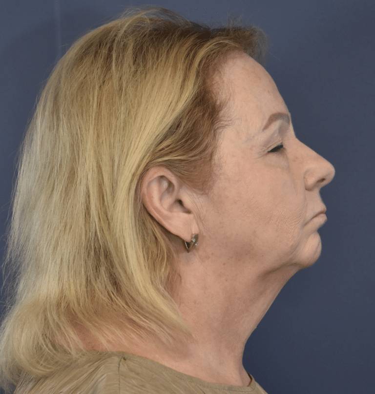 Before Image: Facelift and Neck Lift - right-side