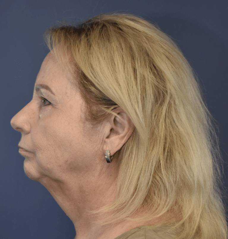 Before Image: Facelift and Neck Lift - left-side