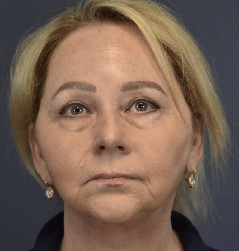 After Image: Facelift and Neck Lift - front
