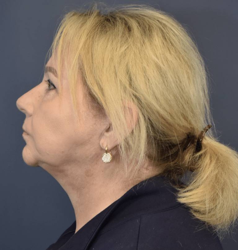 After Image: Facelift and Neck Lift - left-side