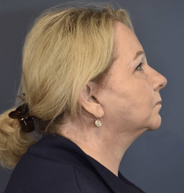 After Image: Facelift and Neck Lift - right-side