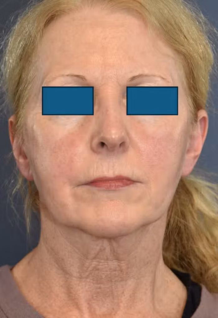 Before Image: Facelift and Neck Lift - front