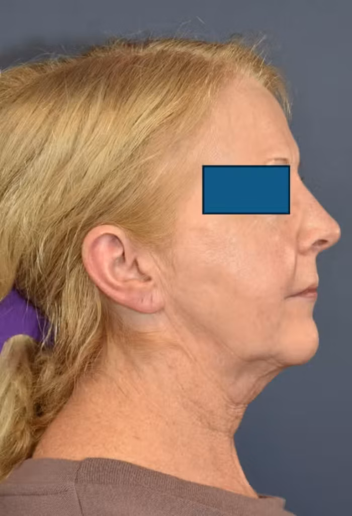 Before Image: Facelift and Neck Lift - right-side