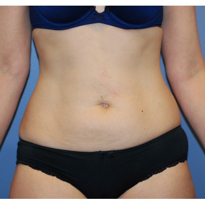 Before Image: Liposuction - other