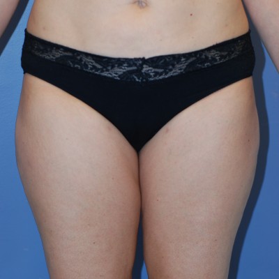 After Image: Liposuction - other