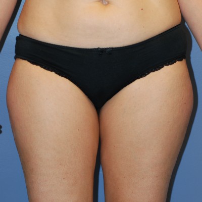 Before Image: Liposuction - other