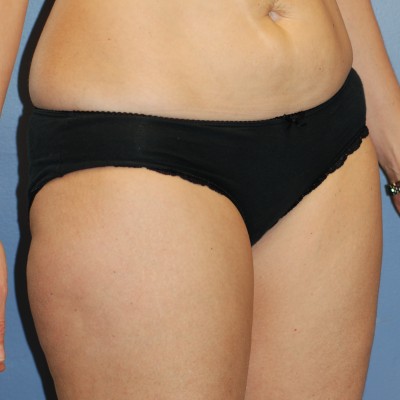Before Image: Liposuction - right-front-oblique