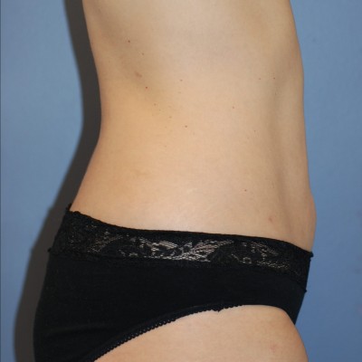 After Image: Liposuction - right-side