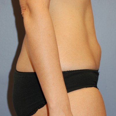 Before Image: Liposuction - right-side