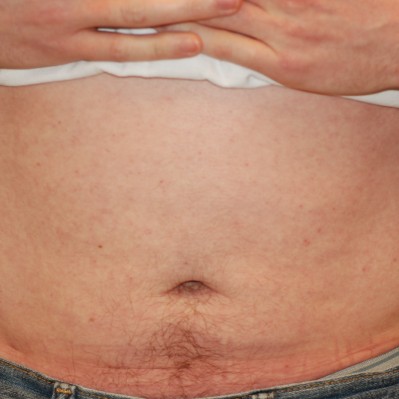 After Image: Liposuction - front