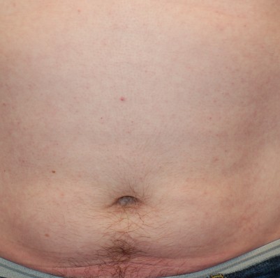 Before Image: Liposuction - front