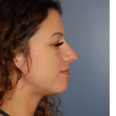 After Image: Rhinoplasty - other