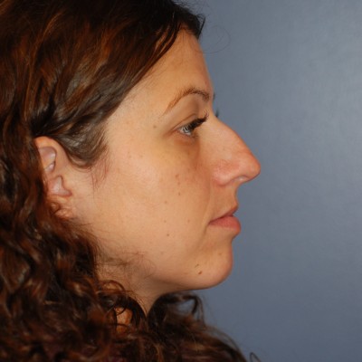 Before Image: Rhinoplasty - other