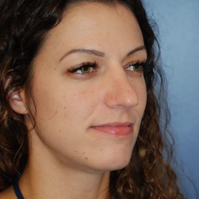 After Image: Rhinoplasty - left-side