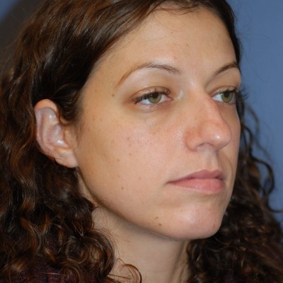 Before Image: Rhinoplasty - left-side