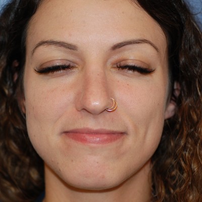 After Image: Rhinoplasty - front