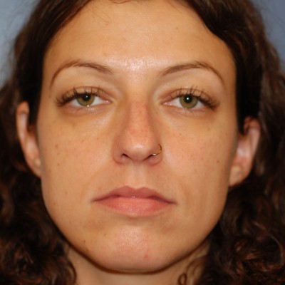 Before Image: Rhinoplasty - front