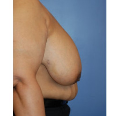 Before Image: Breast Reduction - right-side