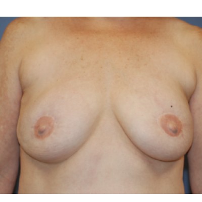After Image: Breast Reconstruction (DIEP Flap & Nipple Tattooing) - front