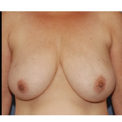 Breast Reconstruction (DIEP Flap & Nipple Tattooing)