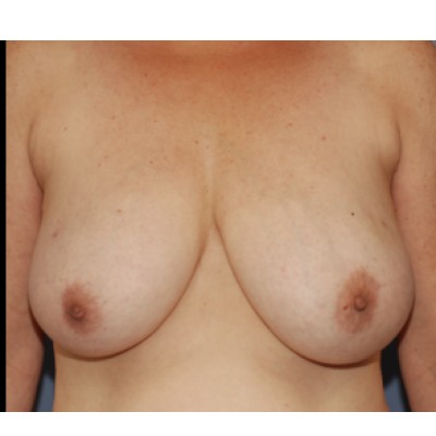 Before Image: Breast Reconstruction (DIEP Flap & Nipple Tattooing) - front