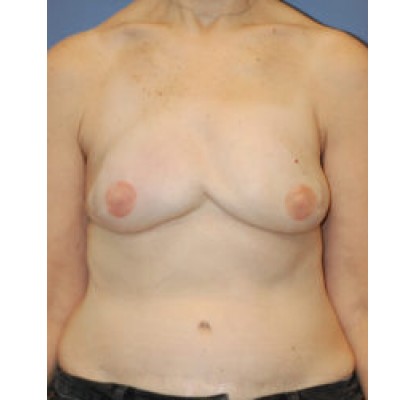After Image: Breast Reconstruction (DIEP Flap) - front
