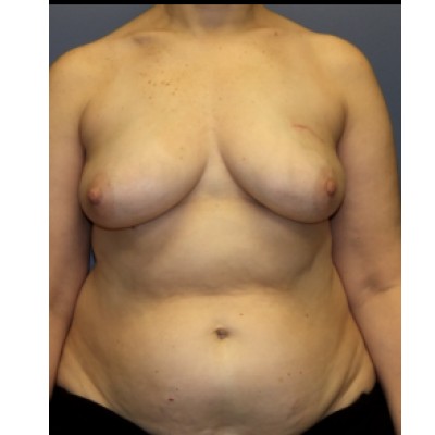 Before Image: Breast Reconstruction (DIEP Flap) - front