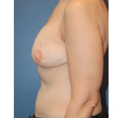 After Image: Breast Reconstruction (DIEP Flap) - front