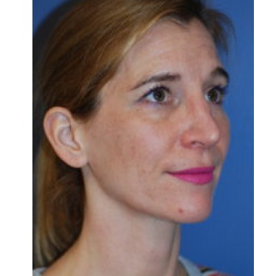 Before Image: Rhinoplasty - other