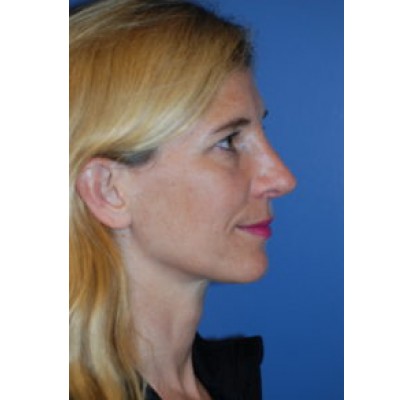 After Image: Rhinoplasty - other