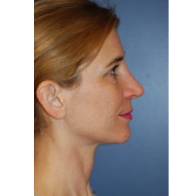 Before Image: Rhinoplasty - other