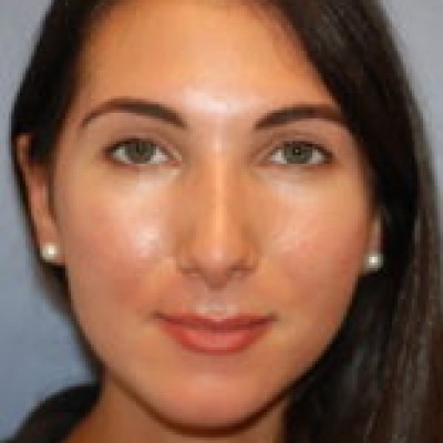 After Image: Rhinoplasty - front