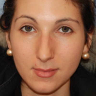 Before Image: Rhinoplasty - front