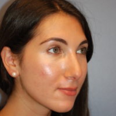 After Image: Rhinoplasty - other