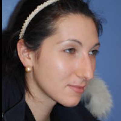 Before Image: Rhinoplasty - other