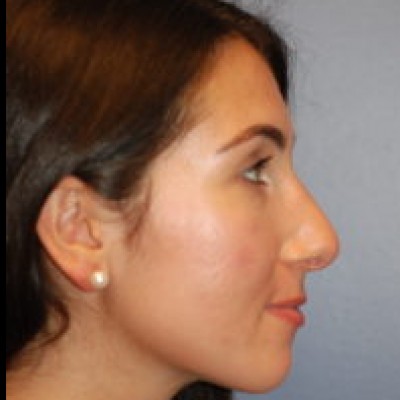 After Image: Rhinoplasty - other