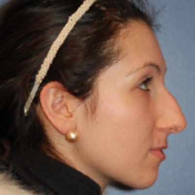 Before Image: Rhinoplasty - other