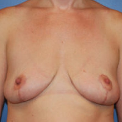 After Image: Breast Reduction - front